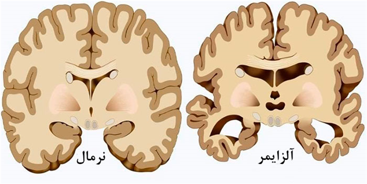 آلزایمر چیست، نشانه هایش کدام است و چه کنیم مبتلا نشویم؟