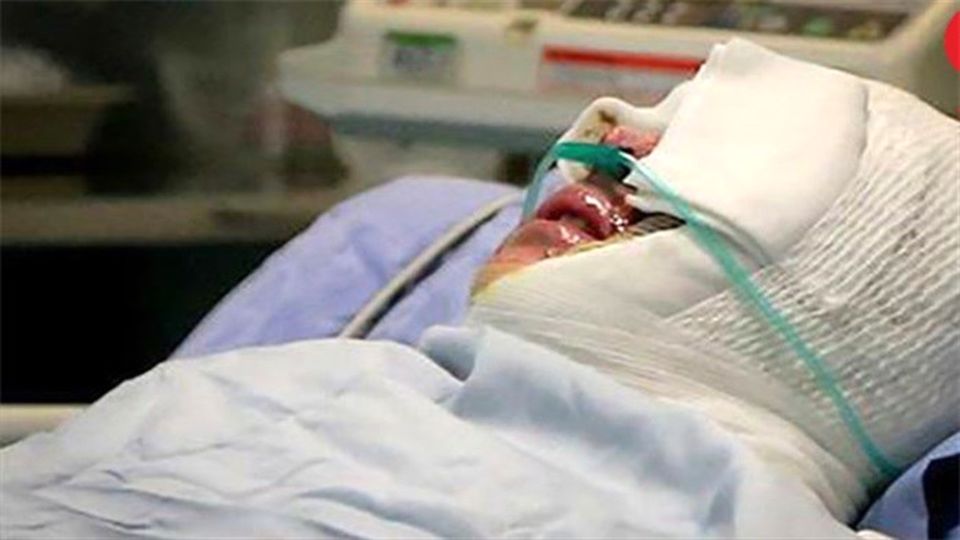 اسیدپاشی  در شهرستان لنده/  زن 19 ساله در خواب قربانی خشونت شد